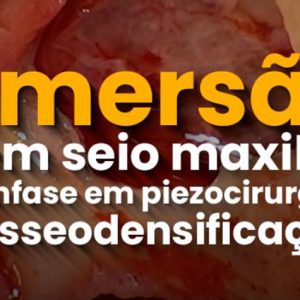Imersão em Seio Maxilar - SP